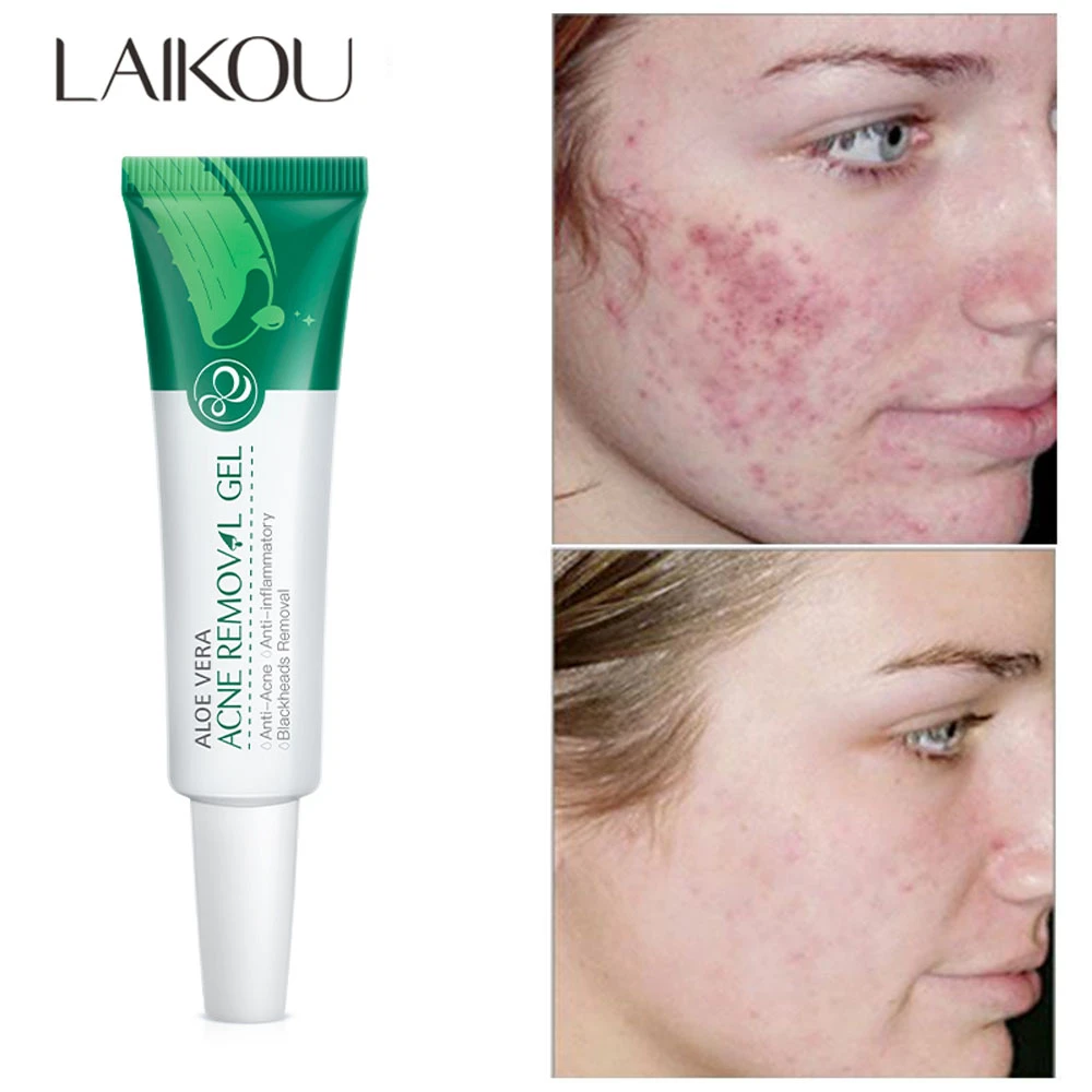 Aloe Acne Treatment Gel Face Serum Hyaluronic Acid Moisturizing Anti Acne Scar Oil Control Soothing Redness Skin Essence Care Serum Aliexpress Aloe Acne Treatment Gel Face Serum Hyaluronic Acid Moisturizing Anti Acne Scar Oil Control Soothing Redness Skin Essence Care Serum Aliexpress