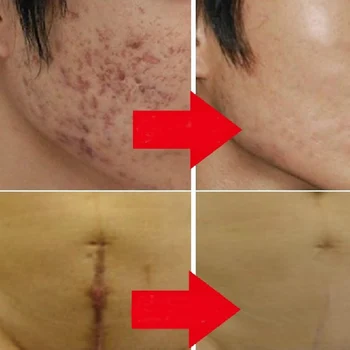 

Nuobisong Facial Scar Removal Cremas Facial Spots Treatment Whitening Face Care Stretch Marks moisturizing