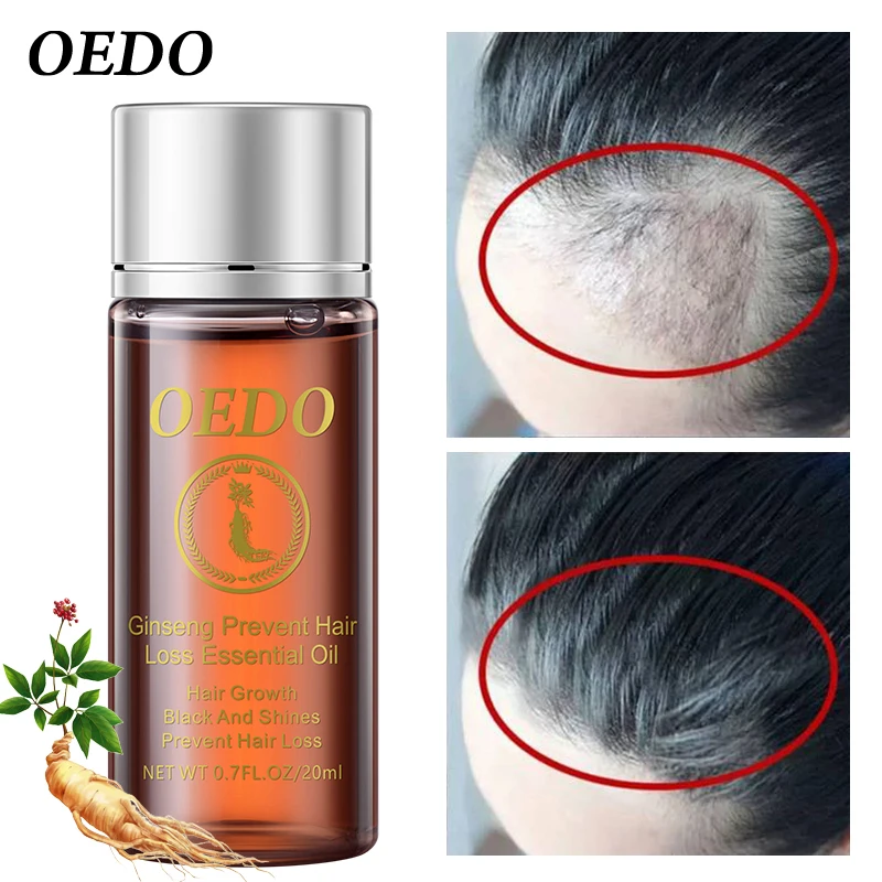 OEDO 2pcs/lot hair fast growing essence for bald essential oil treatment, preventing hair loss, effectively treating dry hair OEDO 2pcs/lot hair fast growing essence for bald essential oil treatment, preventing hair loss, effectively treating dry hair