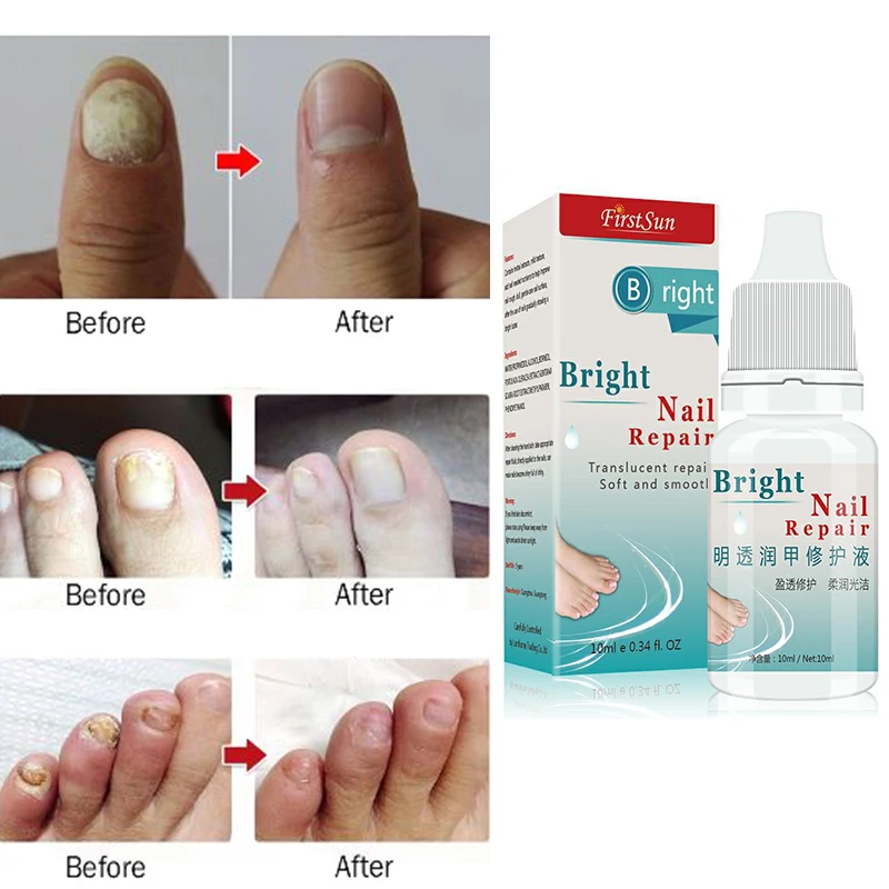 Rapid Deep Sterilization Protect Nail Treatment Solution Toenail Anti Fungus Repair Liquid Moisturizing TSLM2