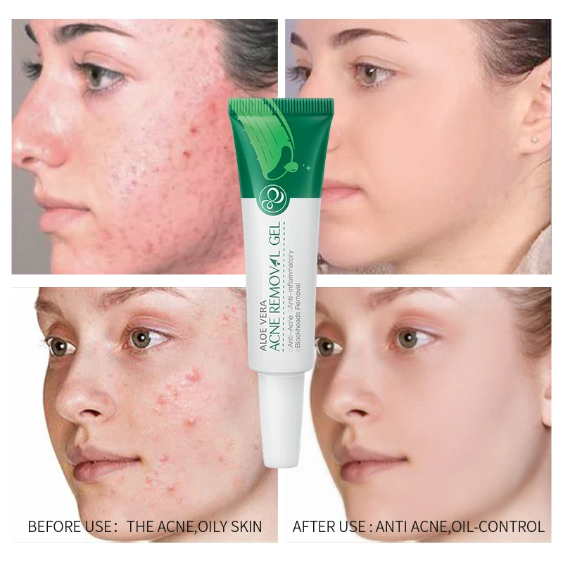 aloe vera and acne