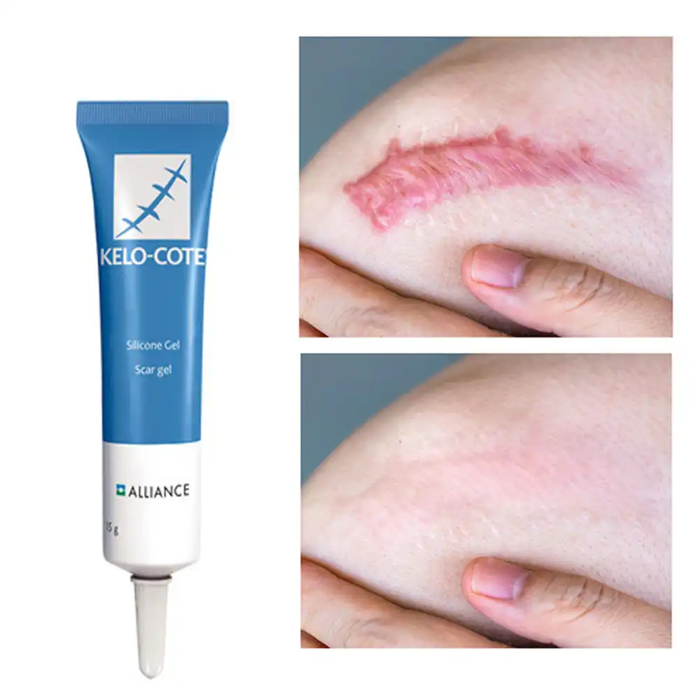 pigmentation marks removal cream