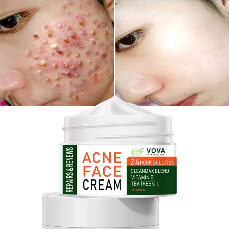 VOVA Effective Acne Removal Cream Acne Treatment Spots Oil Control