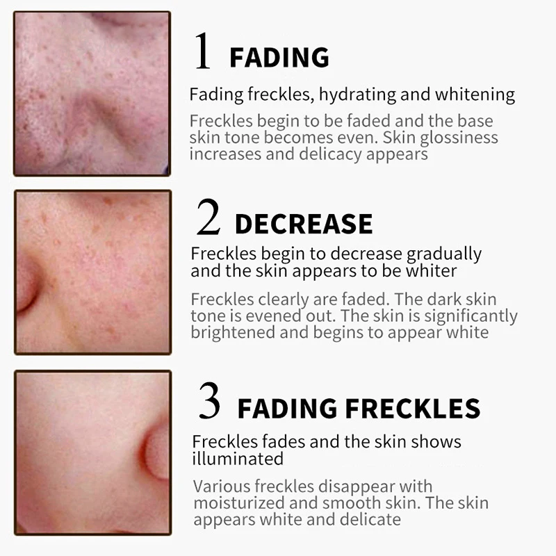 snmlpm freckle cream
