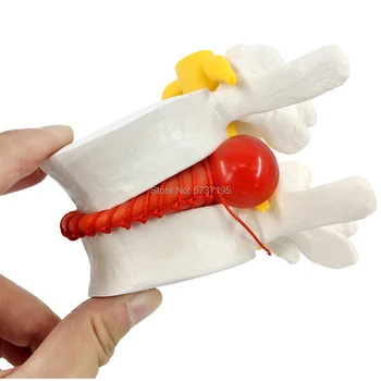 

Human anatomy skeleton spine model with nerve Disc herniation teaching tool medical supplies free shipping for USA