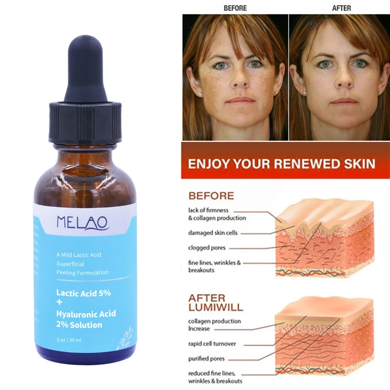 Lactic Acid Skin Peel For Face Acne Wrinkles Melasma Age Spots Brightening Exfloliating