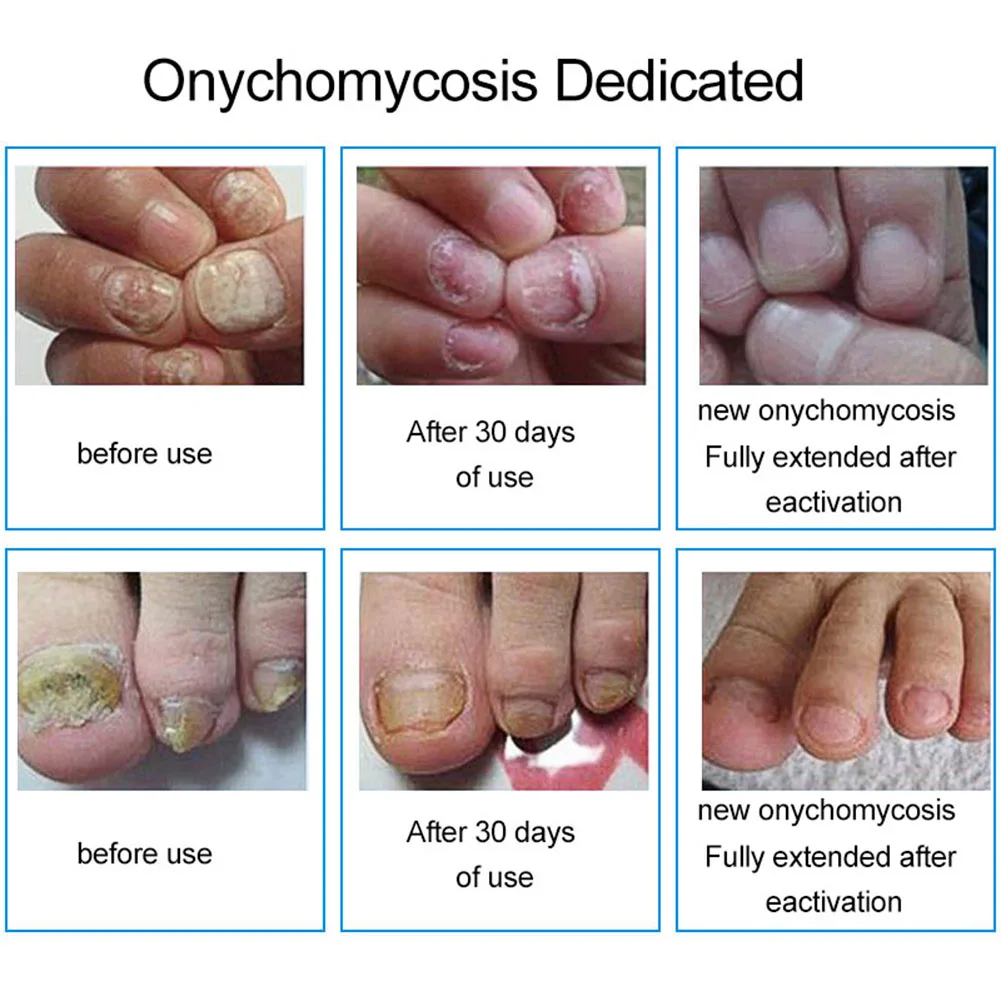 Onychomycosis Paronychia Лечение ногтей Уход за пальцами травяная анти грибок жидкая ручка дизайн ногтей и инструменты маленькая бутылка, дизайн кисти, легко
