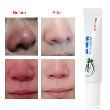 

Rosacea Treatment Cream Nose Redness Removal Cleaning Antibacterial Gel Red Nose Blackhead Remover Skin Care Product