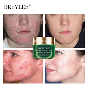 

BREYLEE 20g Acne Treatment Blackhead Remova Anti Acne Cream Oil Control Shrink Pores Acne Scar Remove Face Care Whitening Cream
