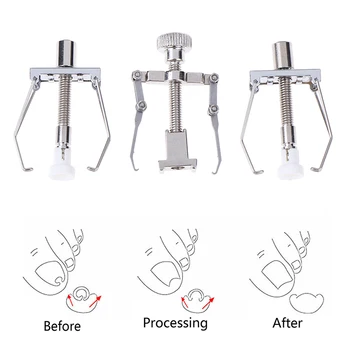 

1 Set Ingrown Toenail Correction Tool Nail Corrector Tool Kit Toe Paronychia Nail Brace Pedicure Care Tool
