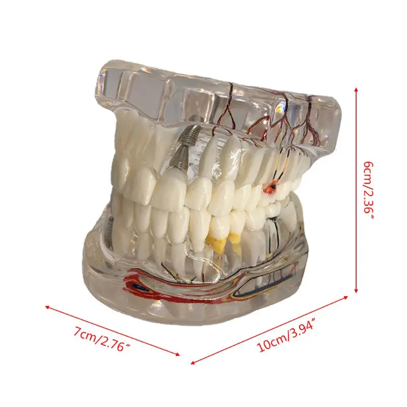 Стоматологическое заболевание имплантата зубы модель с восстановлением мост палочки для очистки зубов для медицинского обучения