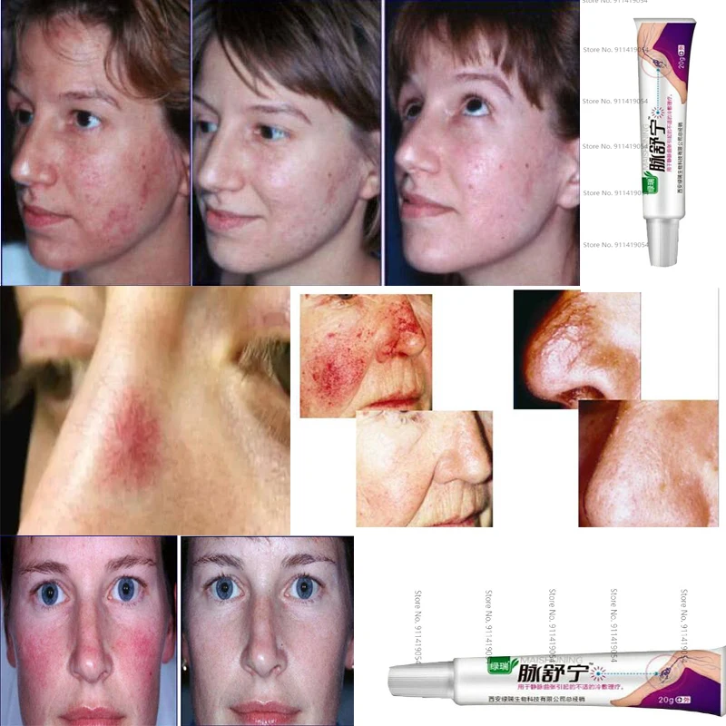 Facial Varicose Vein Cream Anti Redness Spider Remover Advanced Treatment Clearer Skin Veins | Красота и здоровье