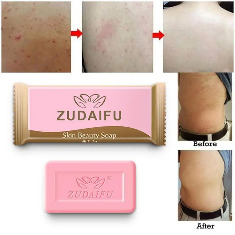 Jabón hecho a mano de azufre, 7g, limpieza de la piel antibacteriana, jabón de baño para el acné y la seborrea, eliminación de ácaros, granos, acné del poro, TSLM2