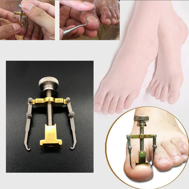 Ingrown Toenails Pedicure Foot Nail Care Tools File for Feet Orthotic Acronyx Ingrowing Nail Onyxis Bunion Corrector for Toes