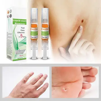 

Skin Tag Remover Pen Wart Remove Liquid Pen Acne Treatment Toe Foot Face Hand Remover Foot Corn Removal Pen TSLM1