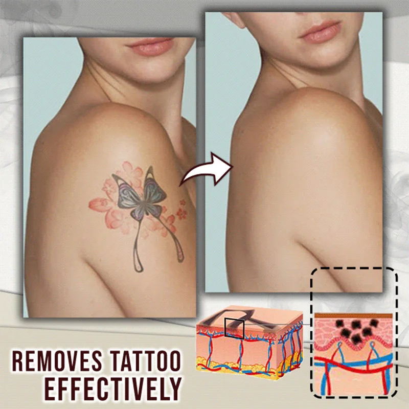 tattoo entfernen creme