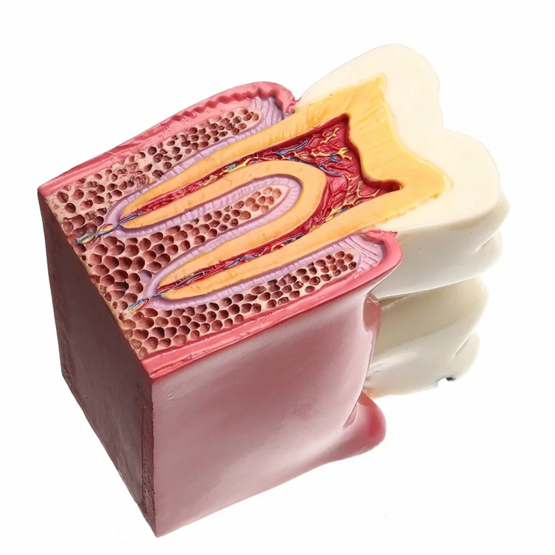 Kopen 1 stuks dental tanden model 6 Keer Cariës Comparation Studie kunstgebit Tand modellen Tandarts Studeren en Onderzoek Tandheelkunde product