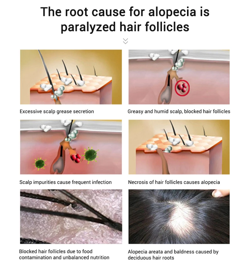 Спрей для роста волос, натуральный имбирь, эссенция, спрей, эффективный экстракт, против выпадения волос, питает корень, уход за волосами, лечение TSLM2