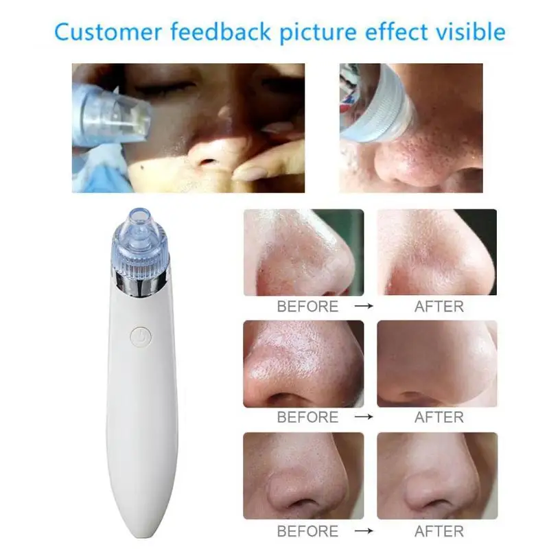 

Facial Vacuum Pore Cleaner Pro Blackhead Vacuum Suction Acne Clean Exfoliating Cleansing Comedo Suction Pore Cleaner