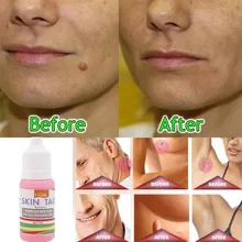 Средство для удаления кожных тегов 12 часов Tu kill медицинский Tu kill для удаления кожных тегов моль и генитальное средство для удаления бородавок для удаления кукурузы на ногах