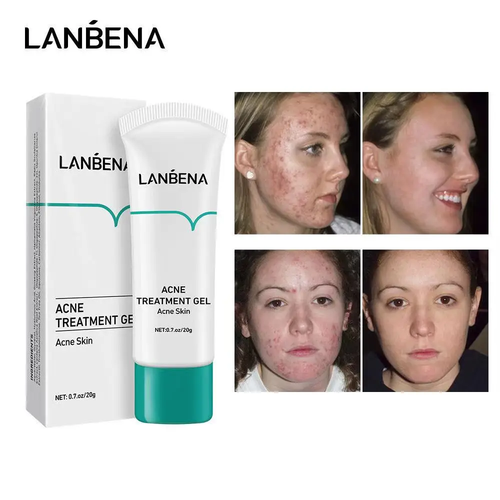 LANBENA-Crema de blanqueamiento del tratamiento del acné, Gel de reparación de espinillas, Control de aceite, reducción de cicatrices de poros, cuidado de la piel hidratante, Corea