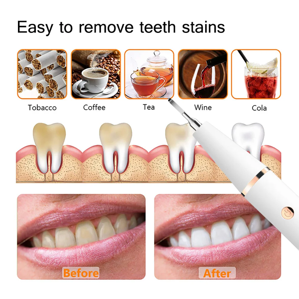 Xiaomi Electric Sonic Dental Calculus Cleansing Oral Teeth Tartar Remover Plaque Stains Cleaner Removal Teeth Whitening