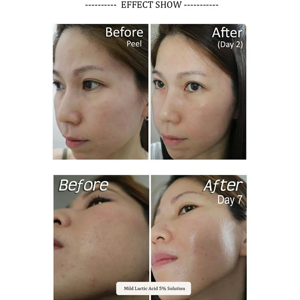 the ordinary peeling solution for blackheads