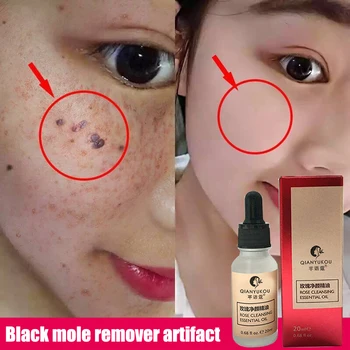 

High Quality Tags Solutions Serum Mole and Skin Painless Solutions Mole Skin Stain Removal Face Wart Sticker Cream 20ML