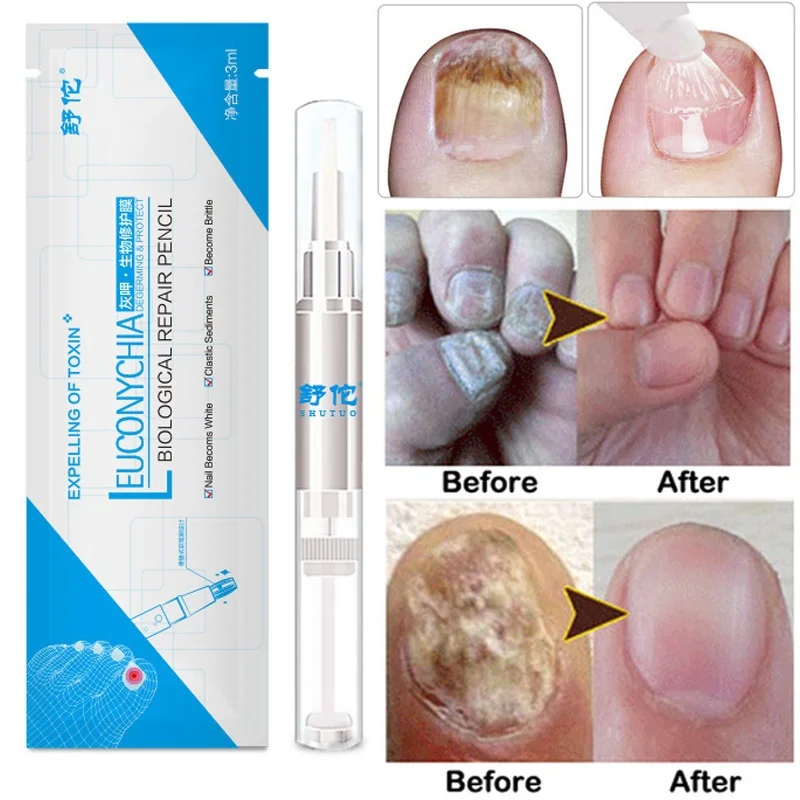  Onychomycosis Paronychia Anti Fungal Nail Infection Liquid Treatment Pen Chinese Herbal Care Medicinal | Красота и здоровье
