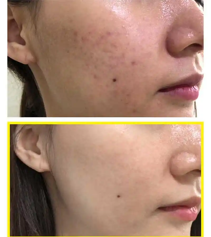yuja niacin for acne