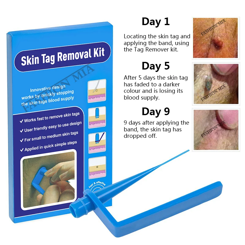 Micro Band Non Toxic Face Care Mole Wart Tool For Small To Medium Blue Skin Tag Removal Kit With Cleansing Swabs Home Use Adult Micro Band Non Toxic Face Care Mole Wart Tool For Small To Medium Blue Skin Tag Removal Kit With Cleansing Swabs Home Use Adult
