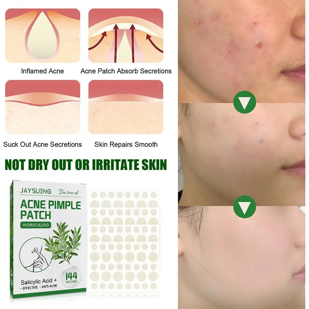 144patch Acne Pimple Patches Translucent Matte Hydrocolloid Salicylic Acid Tea Tree Oil For Inflamed Acne Improve Whiteheads 6