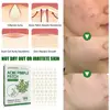 144patch Acne Pimple Patches Translucent Matte Hydrocolloid Salicylic Acid Tea Tree Oil For Inflamed Acne Improve Whiteheads 6