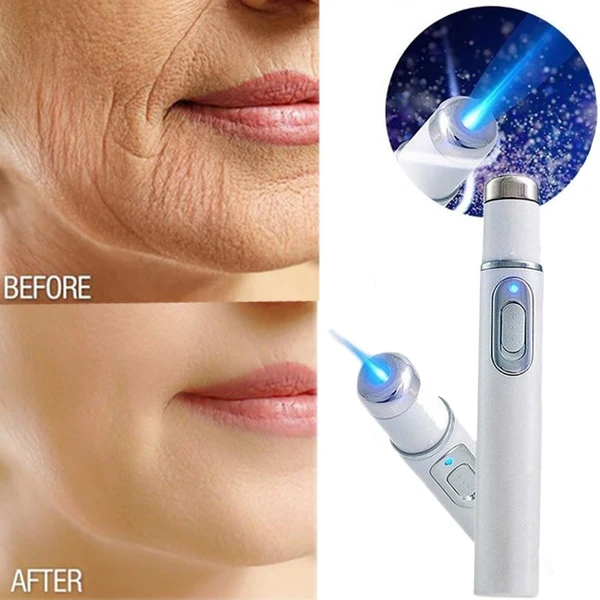 Acne Wrinkle Removal Laser Pen 1