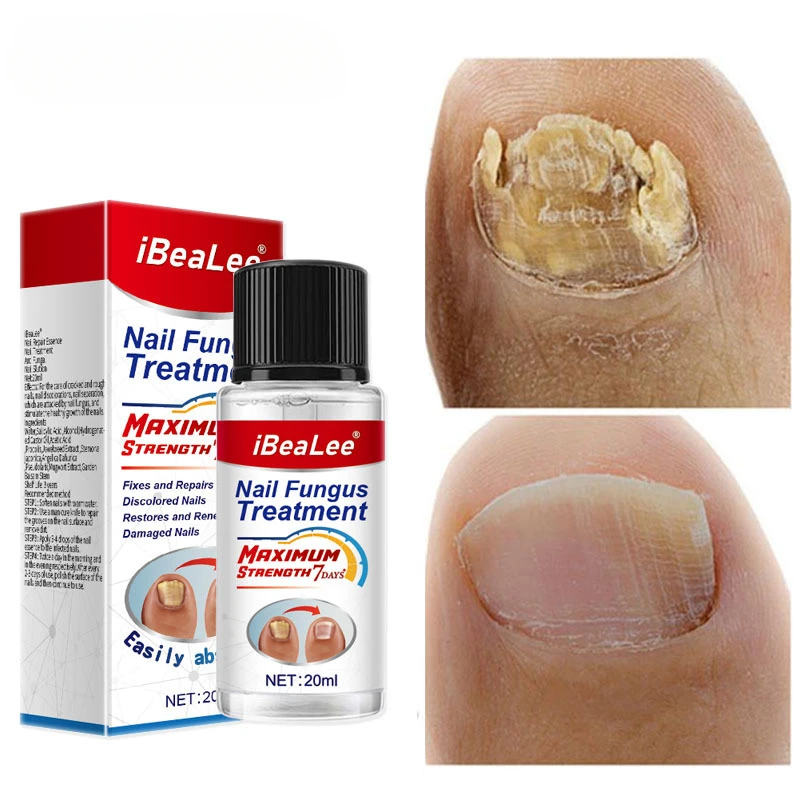 Nail Care Essence-Liquid Repairing Yellowing and Thickening Gray Nails of Hands and Feet Nail Moisturizing Liquid 20ml U&ntilde;as