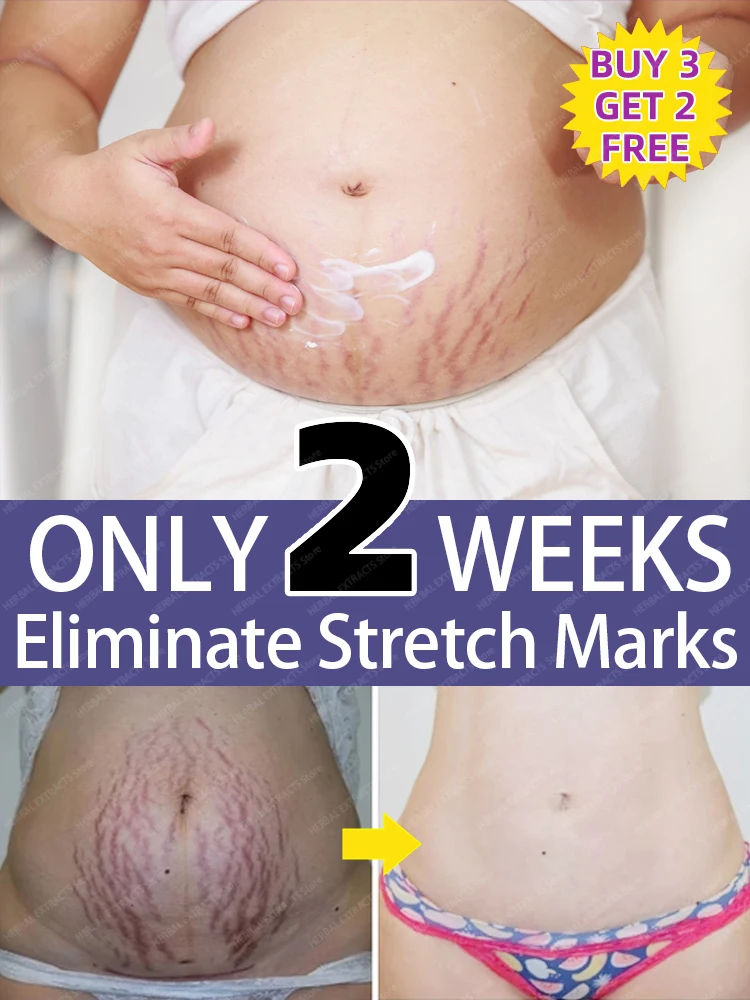 

Stretch Marks Permanent Removal Cream Eliminate Body Belly Stretch Marks For Tunnels