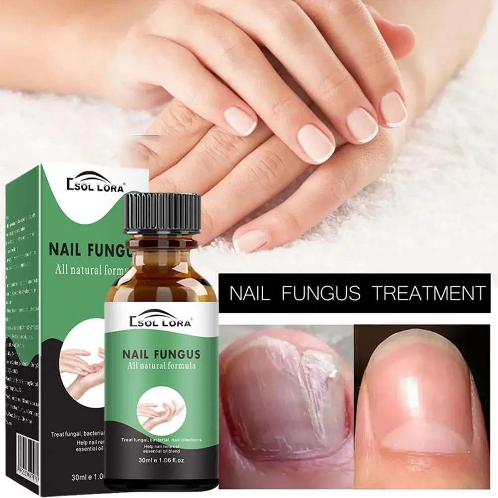 Paronychia Relief Gel Oil Nail Repair Liquid Moisturizing Regeneration Straighting Nail Removal Healthy Correct Distorted S E0E5