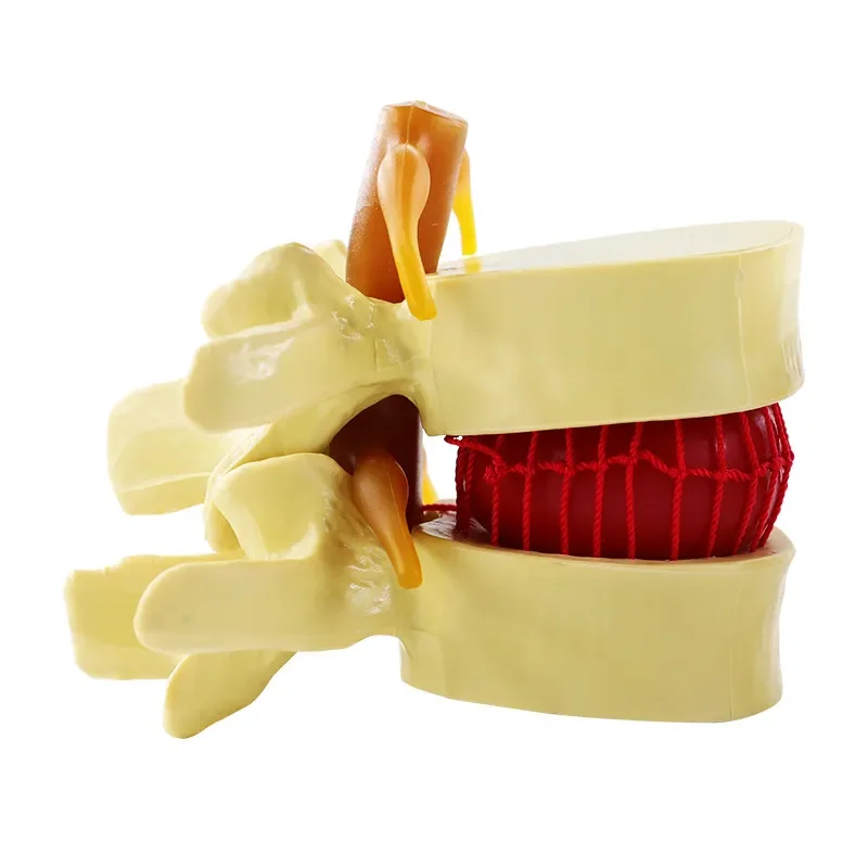 

Human 1.5X Anatomical Spine Lumbar Herniation Intervertebral Disc for Medical Study Teaching Orthopedics Display Medical Model