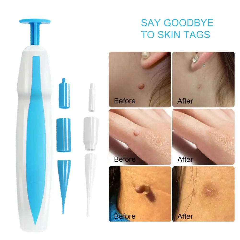 1 Set Skin Tag Remover Convenient Safe Non-irritating Skin Care Plastic Skin Tag Removal Kit Blemish Remover