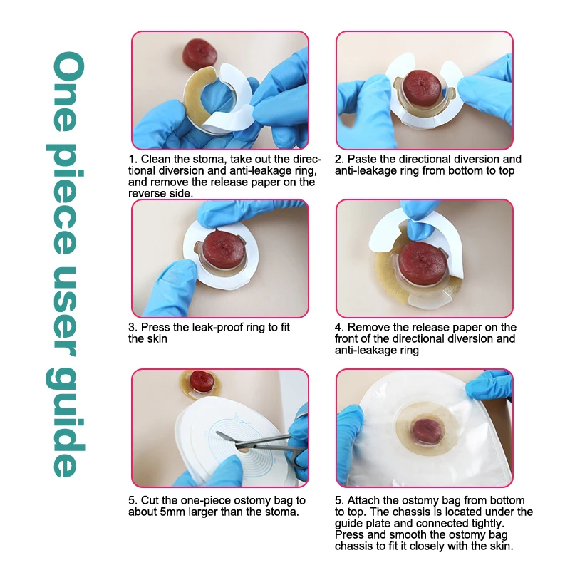 Anti-Leakage Ring For Colostomy Bag Ostomy Paste Ring Base Plates Stoma Care Products To Protect Skin