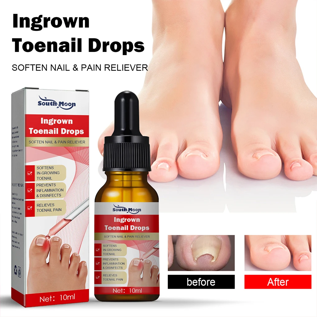 Ingrown Toenail Drops Fluid Soften Application Straightening Nail Essence Accessory 10ml for manicure pedicure tools