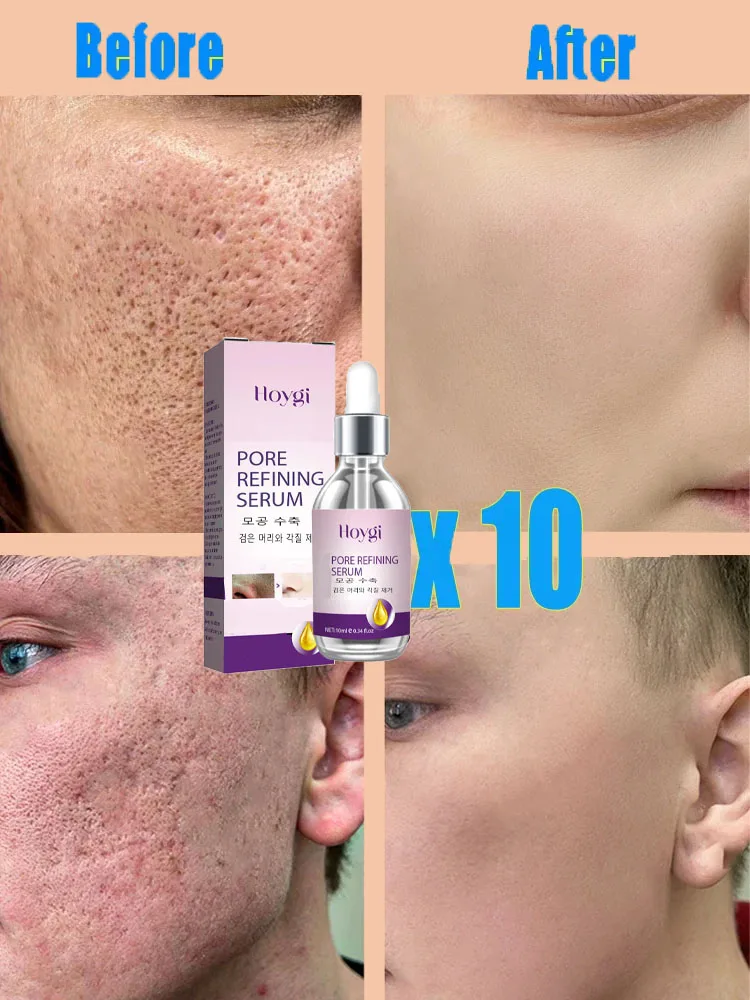Skin texture, pore refinement and regeneration, no acne facial essence