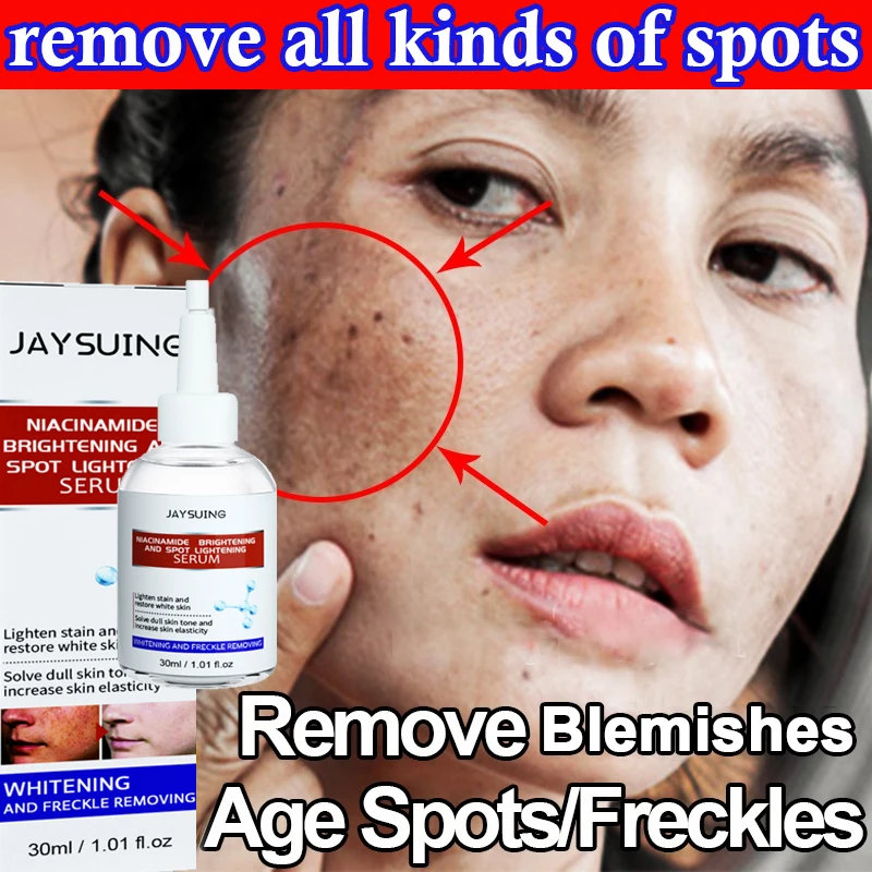 

Freckles Removal Serum Cream Remove Facial Spots Dark Spot Removal Melasma Age Spots Sunspots Whitening Freckle Cream Remover