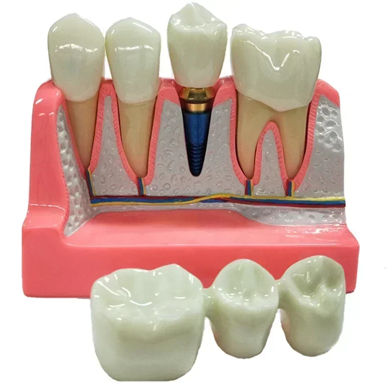 Dental Teaching Model Removable Porcelain Teeth Demonstration
