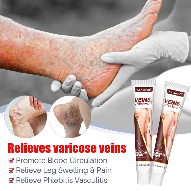 20g Varicose Vein Relief Cream Improves Blood Circulation Relaxing Leg Cream Relieve Spider Blood Vessels Anti Varicose pain analgesic cream varicose veins patch