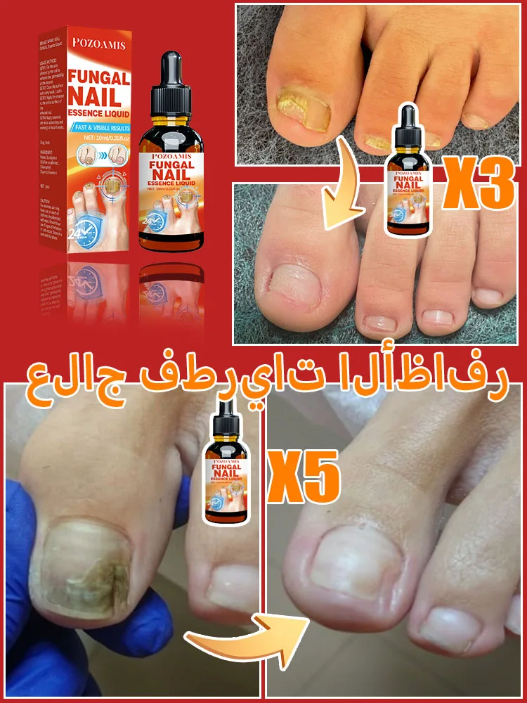 Fungal Nail Product fungus solution