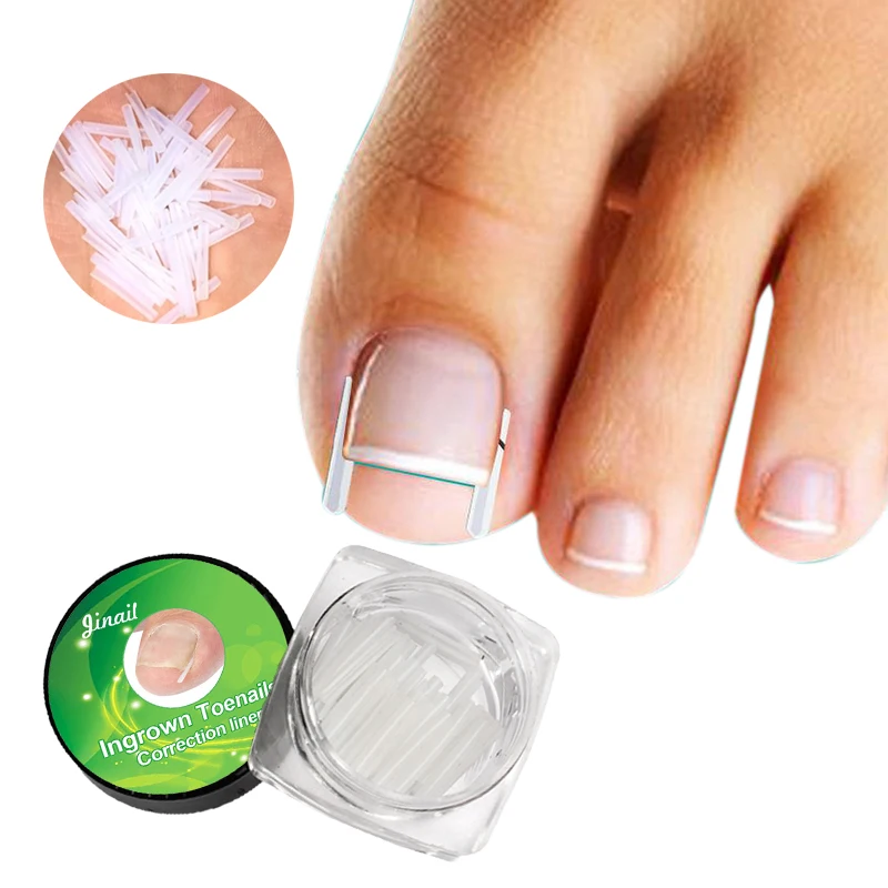 Silicone Nail Tools Stickers Toenail Correction Straightener