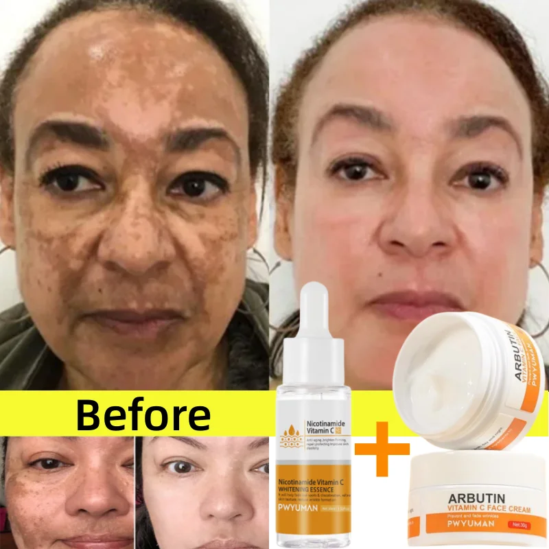 Vitamin C Whitening Freckles Serum Cream Remove Dark Spots Melasma Niacinamide Lighten Melanin Acne Scars Anti-aging Skin Care vitamin c brighten whitening serum niacinamide remove freckle dark spots melasma melanin anti aging moisturizing skin care 30ml