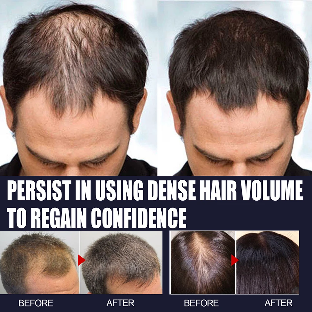 30ml Hair Growth Essential Oil Anti shedding Fast Growth Denser Solid