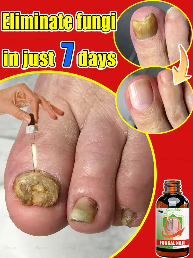 2025 Technology Eliminate Fungus And Restore Health fungus solution